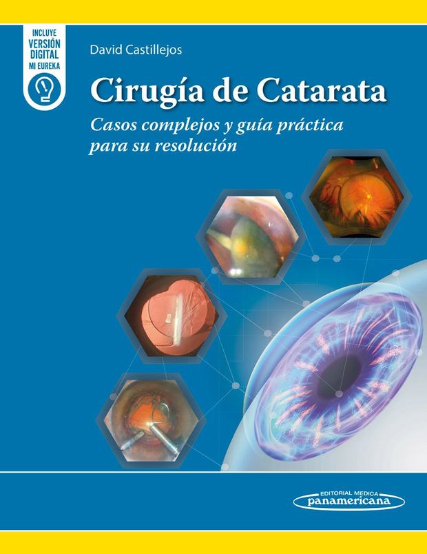 Portada de Cirugía de Catarata